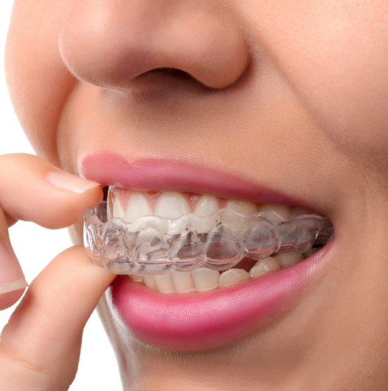 Invisalign / Ortodoncia sin brackets